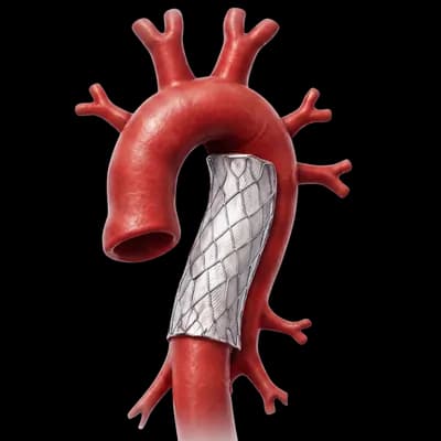 Aortic Aneurysm & Aortic Surgery