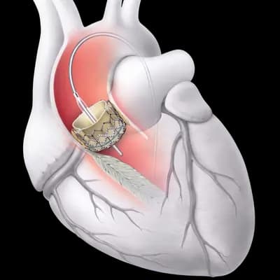 TAVI / TAVR Procedure