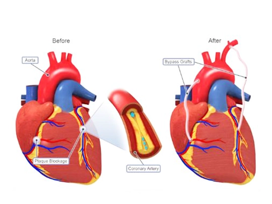 HeartBypassProcedure-CABGSurgeryinMumbai-Dr.AmjadShaikh HeartBypassProcedure-CABGSurgeryinMumbai-Dr.AmjadShaikh